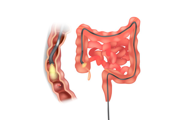 结肠息肉病因及病理生理变化