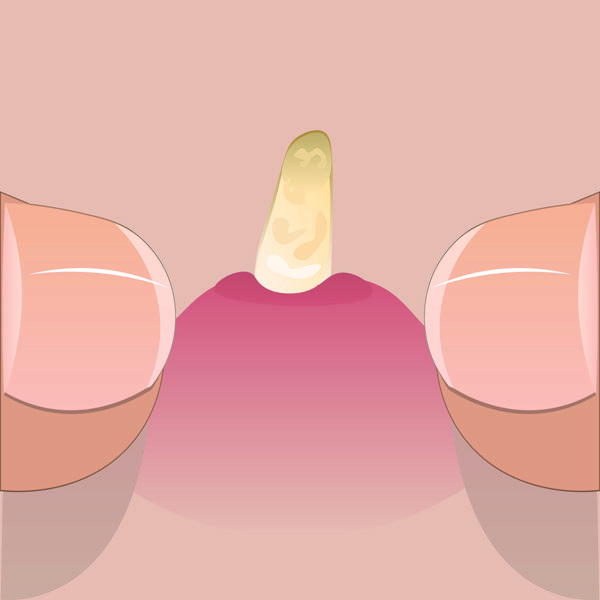 阴囊上皮脂腺囊肿可以用药物吗