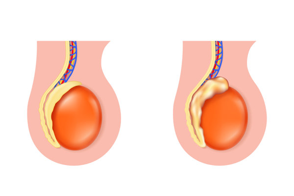 婴儿睾丸肿起来是什么原因