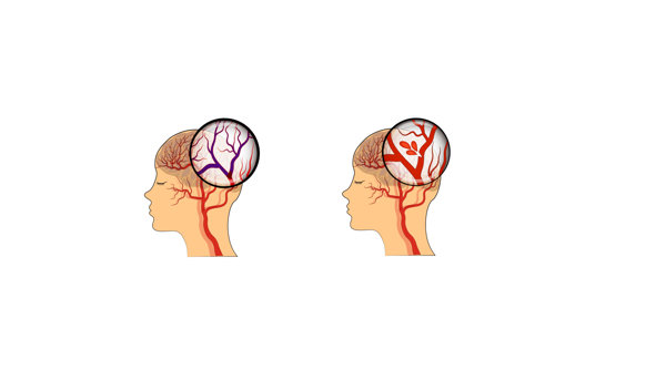 腔梗缺血严重吗