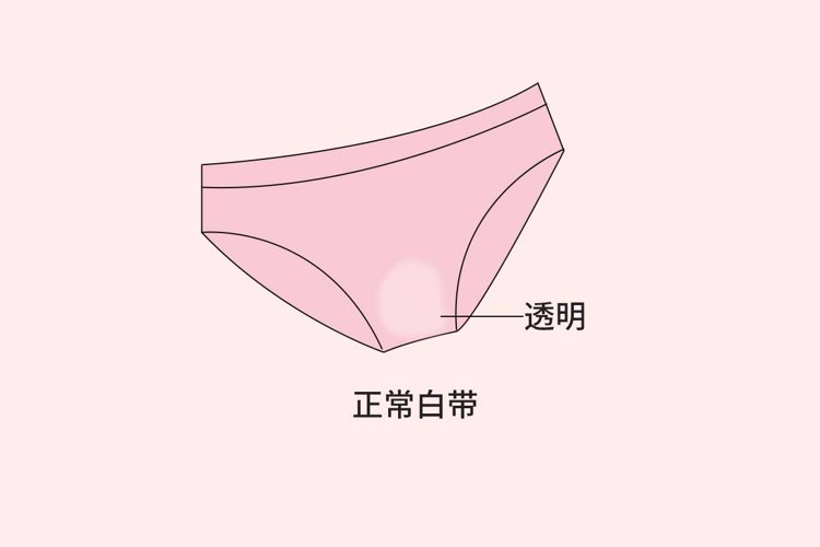 1个月不换内裤，23岁姑娘确诊外阴癌前病变，她的坏习惯你有吗