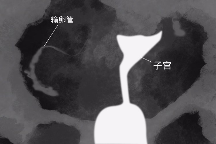 妇产医院输卵管造影一点都不疼！别犹豫冲啊