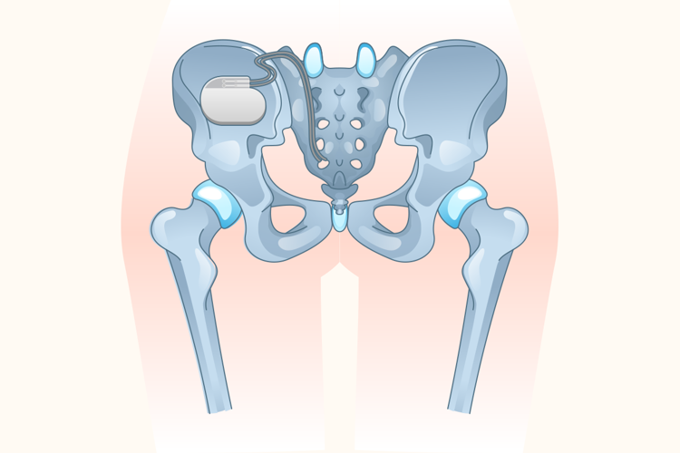 一打喷嚏、咳嗽就漏尿？别害羞，这是病！易在4类人身上出现