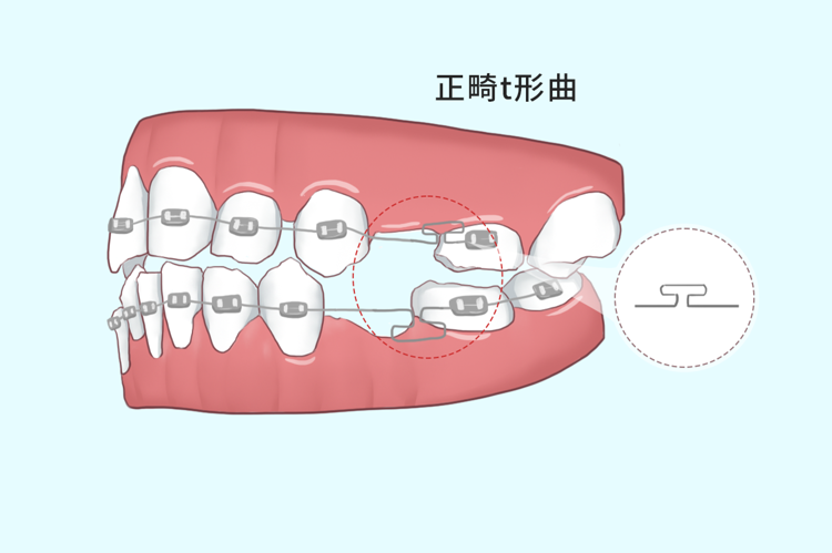 正畸矫正为什么要打骨钉（支抗钉）第二篇