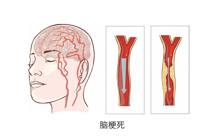人到中年，头部出现4种“异常”，或是脑梗来临前兆，尽早预防