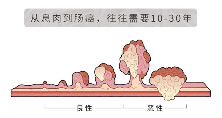 再次提醒:肠息肉不想变肠癌,3种东西尽量少吃,再馋也要克制住