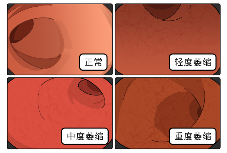 从胃炎到胃癌，大概需要几年？提醒：抓住5个癌变信号，及时刹车