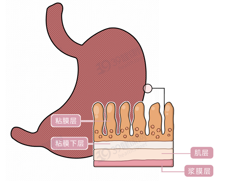 从胃炎到胃癌，大概需要几年？提醒：抓住5个癌变信号，及时刹车