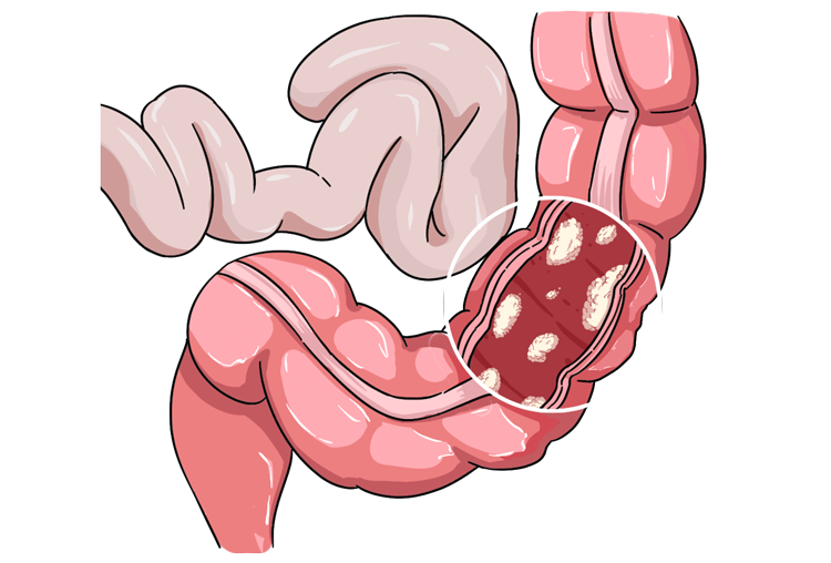 你以为的“上火”，可能是癌症预警，出现5种症状，别疏忽大意