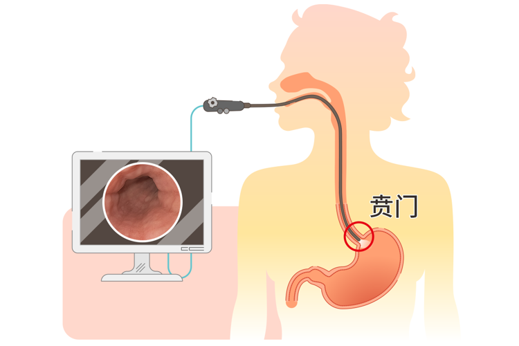 从胃炎到胃癌，大概需要几年？提醒：抓住5个癌变信号，及时刹车
