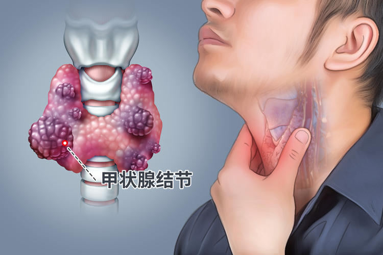 息肉、结节、囊肿、增生,哪些易癌变?哪些不用治?一文全告诉你