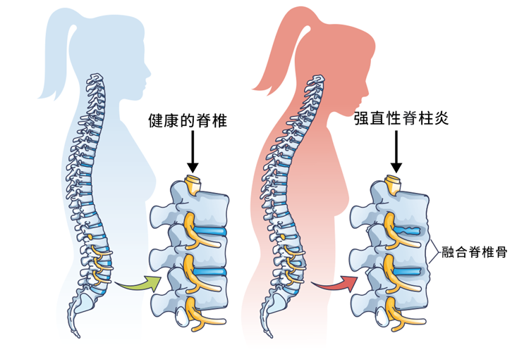 42岁男子深夜腰痛,第二天猝死,提醒:腰痛或是疾病和癌症信号