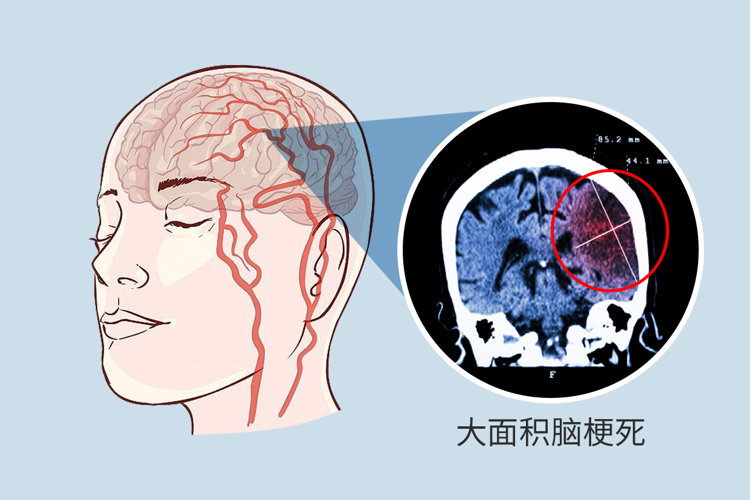 3大症状提示脑供血不足!提醒:不想脑梗或痴呆,提前做好4件事