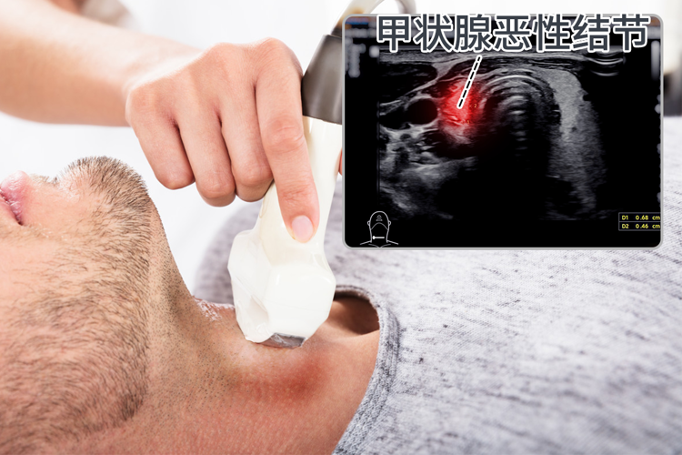 息肉、结节、囊肿、增生,哪些易癌变?哪些不用治?一文全告诉你