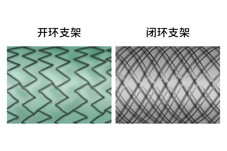 国内将逿¸åœæ¢å¿ƒè„支架手术?支架究竟是利大还是弊大,真相æ¥äº†