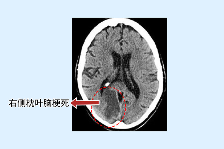 脑梗是“吃”出来的？劝告：这3种食物易堵塞血管，尽早撤下餐桌