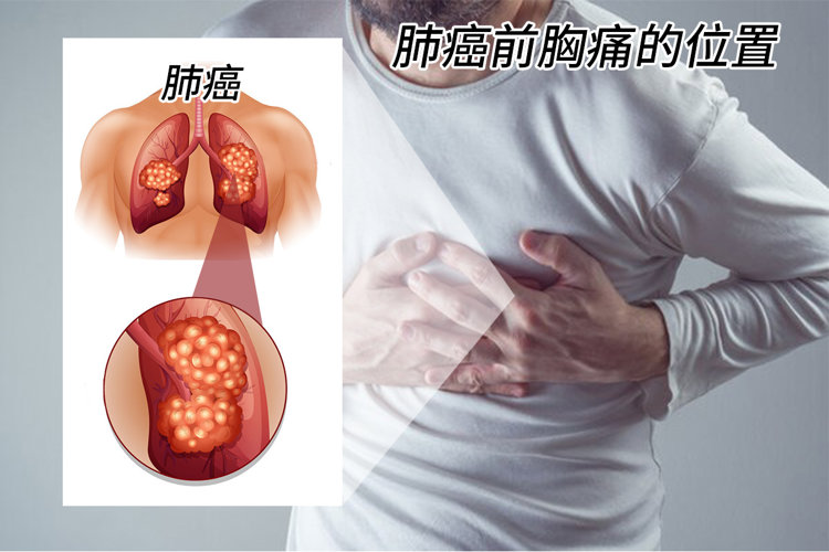 男子肩痛半个月查出肺癌，医生提醒：4种肩痛可能是大病的信号