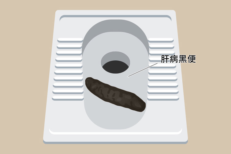 肝癌一发现就是晚期?上厕所时出现3个异常,建议尽早排查肝病