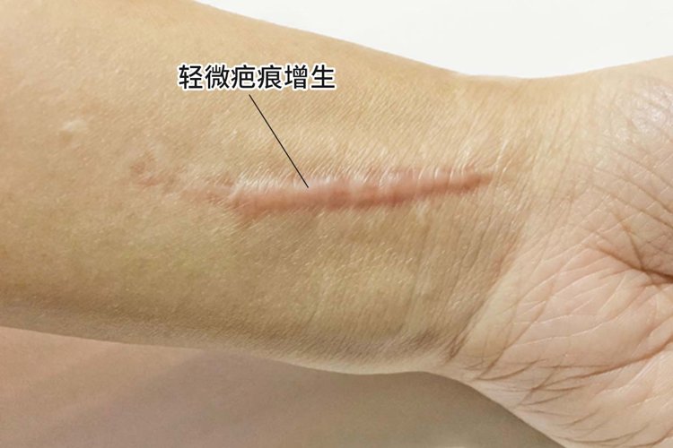 息肉、结节、囊肿、增生,哪些易癌变?哪些不用治?一文全告诉你
